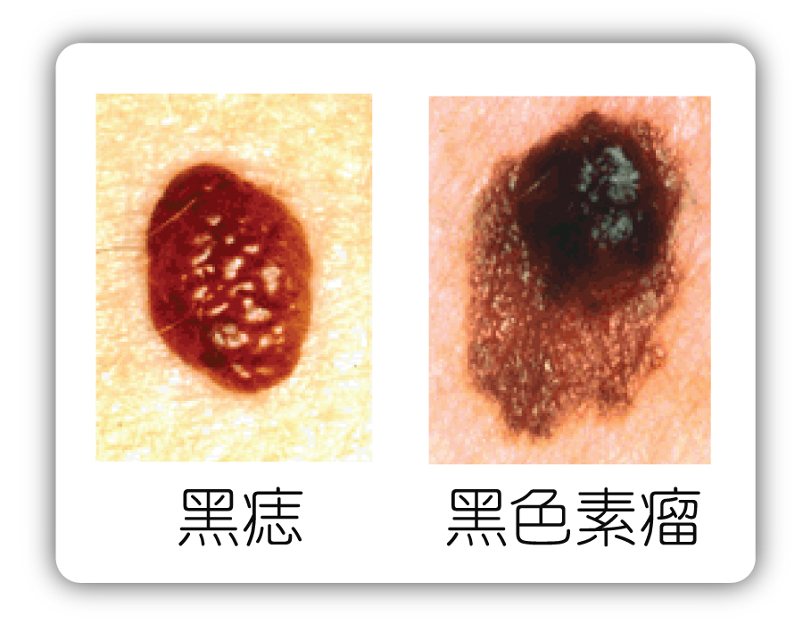 皮膚中的不速之客黑色素瘤 百本生活雜誌